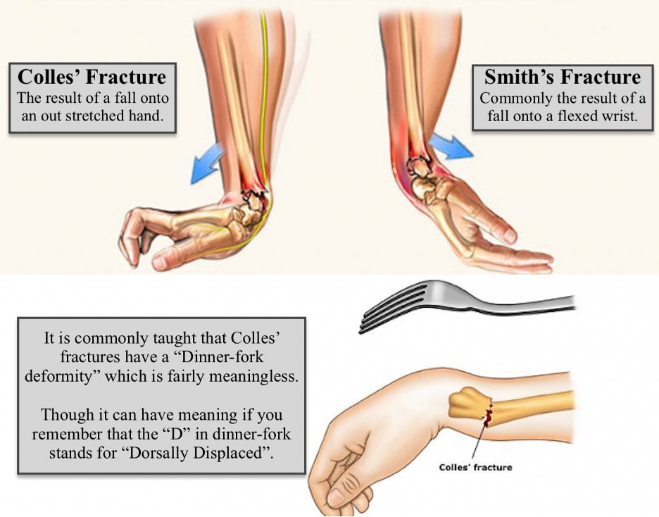 dr. hezam. m. alqadhy on X: @IhabFathiSulima A Colles' fracture is a type  of fracture of the distal forearm in which the broken end of the radius is  bent backwards.  /
