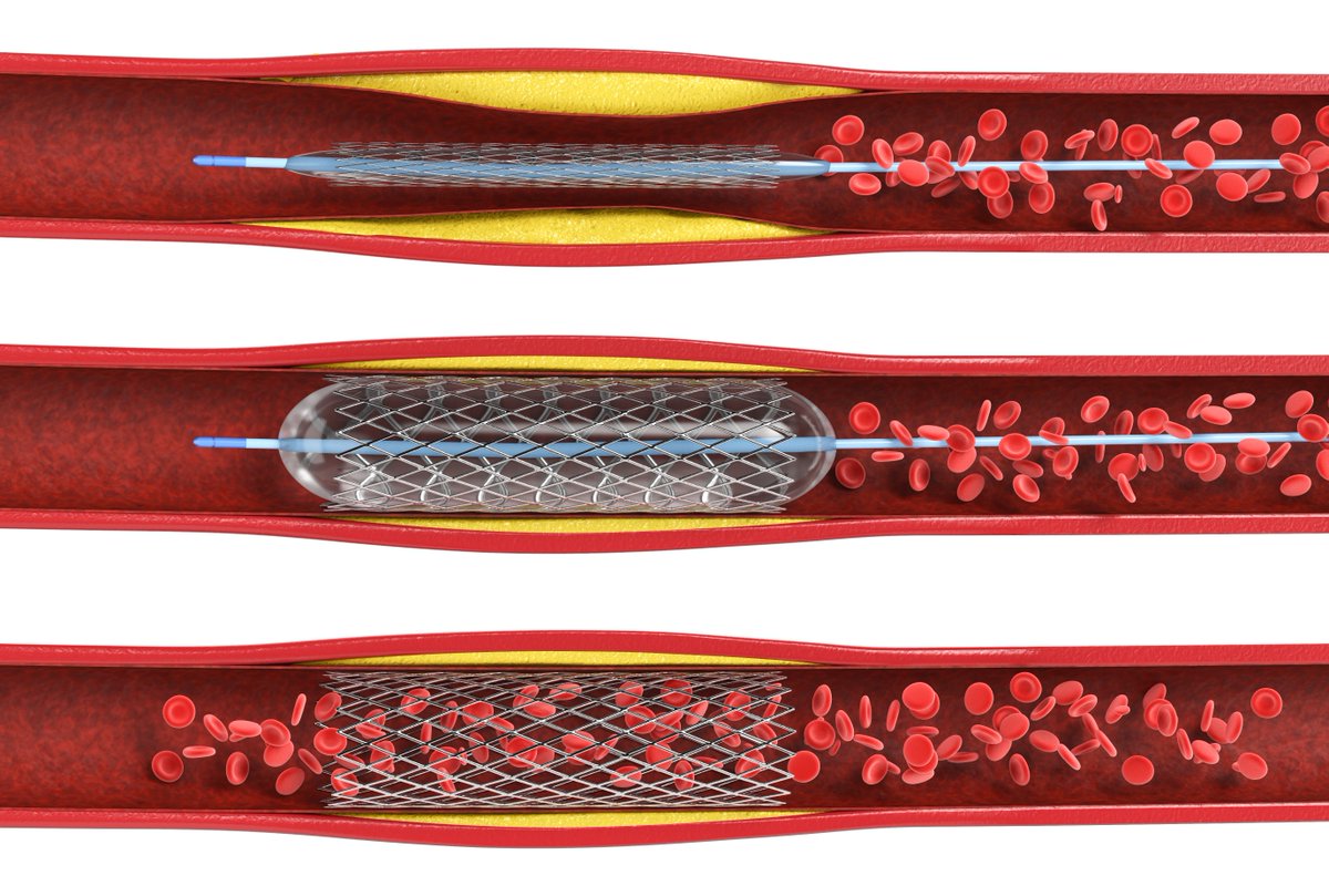 ACCinTouch's tweet image. New analysis from #ISCHEMIA shows early #revascularization by #PCI and #CABG was associated w/ higher early risks and lower long-term risks of CV events compared w/ a conservative strategy. Read more: bit.ly/3QSfy9N #AHA23 @JACCJournals #JACC