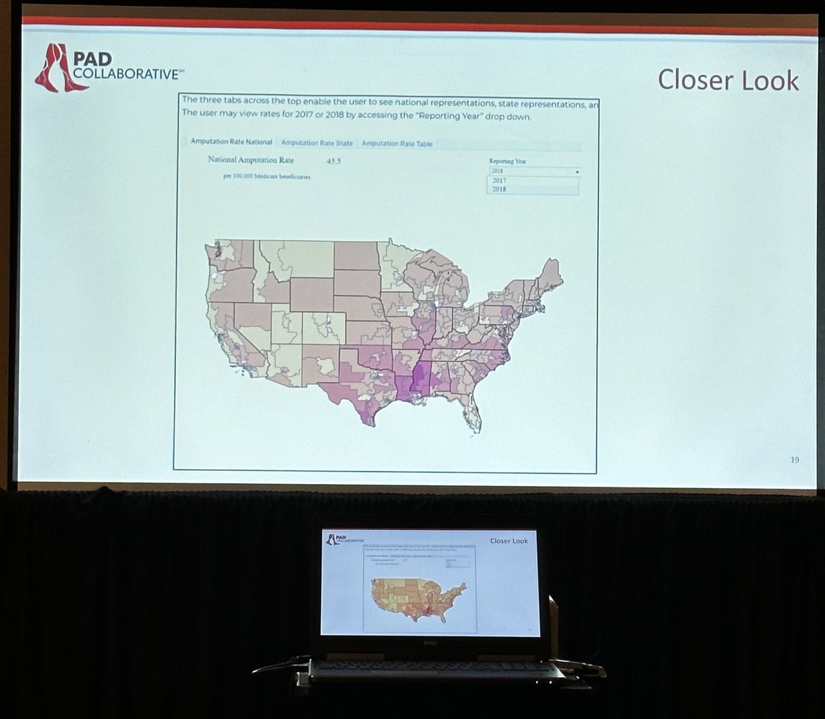 A scary map! #PADCollaborative Calling all of you to be a FORCE to fight against the amputation epidemic #AHA23 #PADCollaborative #CLTI #Amputationmap @PVDCouncil @AHAScience @AHAMeetings #structuralracism #ampute #PAD @hmpVDM @VMJ_SVM #SVM