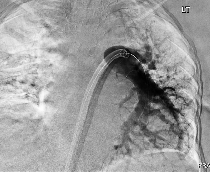 mahmoudali_md's tweet photo. Saddle emboli. HR 160, Saturation 86 on 8 liters Oxygen, elevated troponin, with right ht strain. 
after INARI thrombectomy, HR 72, Saturation 94 on room air. Mean PA pressure from 50 to 32. Immediate results are amazing. Why I love being an IR. 
@SIRspecialists  @_backtable https://t.co/GtZG2249qa