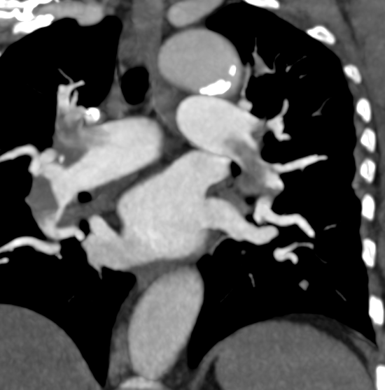 Mahmoud Ali MD (@mahmoudali_md) on Twitter photo Saddle emboli. HR 160, Saturation 86 on 8 liters Oxygen, elevated troponin, with right ht strain.
after INARI thrombectomy, HR 72, Saturation 94 on room air. Mean PA pressure from 50 to 32. Immediate results are amazing. Why I love being an IR.
<a href="/SIRspecialists/">Society of Interventional Radiology</a> <a href="/_backtable/">BackTable Vascular and Interventional</a> Saddle emboli. HR 160, Saturation 86 on 8 liters Oxygen, elevated troponin, with right ht strain.
after INARI thrombectomy, HR 72, Saturation 94 on room air. Mean PA pressure from 50 to 32. Immediate results are amazing. Why I love being an IR.
<a href="/SIRspecialists/">Society of Interventional Radiology</a> <a href="/_backtable/">BackTable Vascular and Interventional</a>