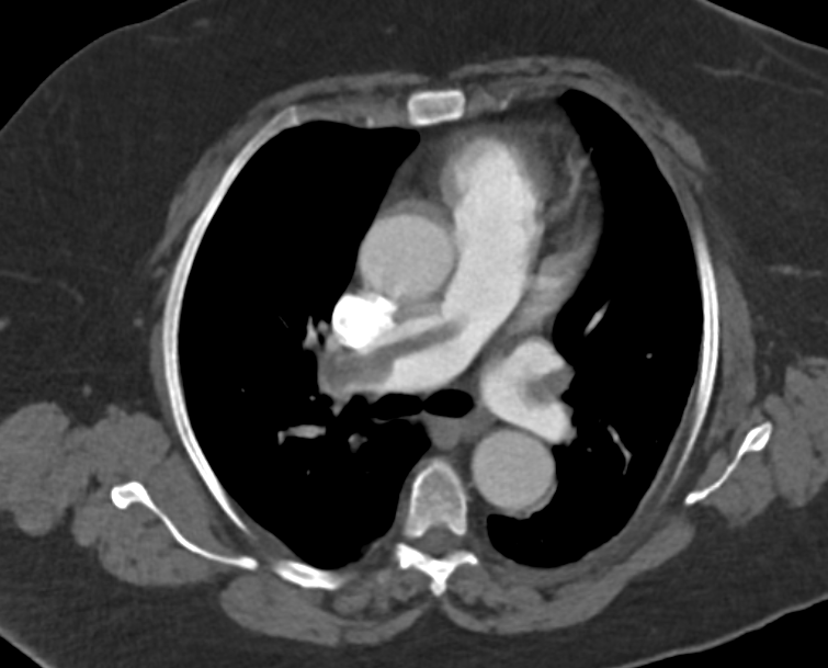 mahmoudali_md's tweet photo. Saddle emboli. HR 160, Saturation 86 on 8 liters Oxygen, elevated troponin, with right ht strain. 
after INARI thrombectomy, HR 72, Saturation 94 on room air. Mean PA pressure from 50 to 32. Immediate results are amazing. Why I love being an IR. 
@SIRspecialists  @_backtable https://t.co/GtZG2249qa
