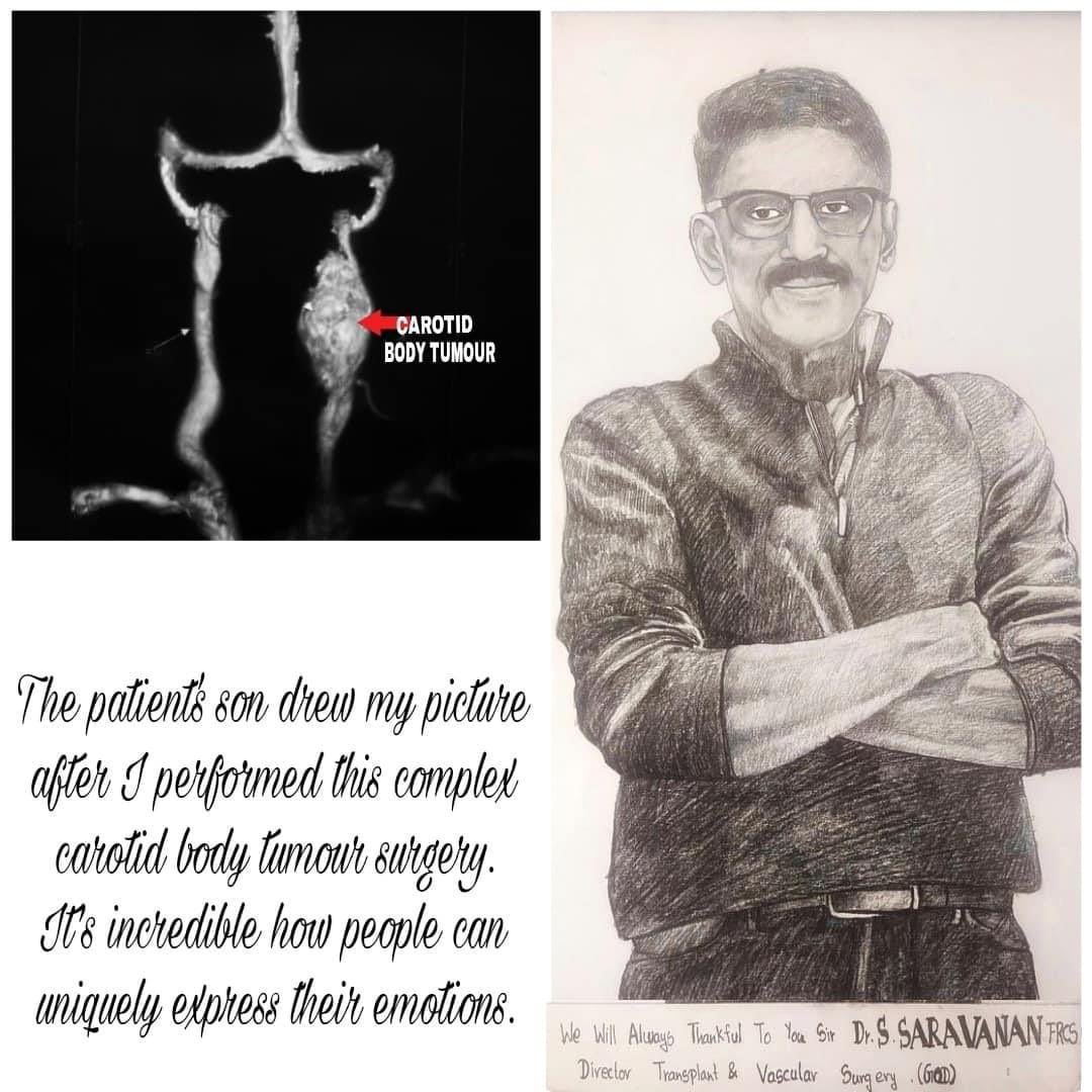 ART CAN BE POWERFUL FORM OF COMMUNICATION & CONNECTION

#drsaravanansundararaj #vascularsurgery
#transplantsurgery
#madrasmedicalmissiom
#peripheralvasculardisease
#diabeticleg
#diabetis
#smoking
#bypasssurgery
#PTFEgraft
#amputationprevention
#veins #venousinsufficiency