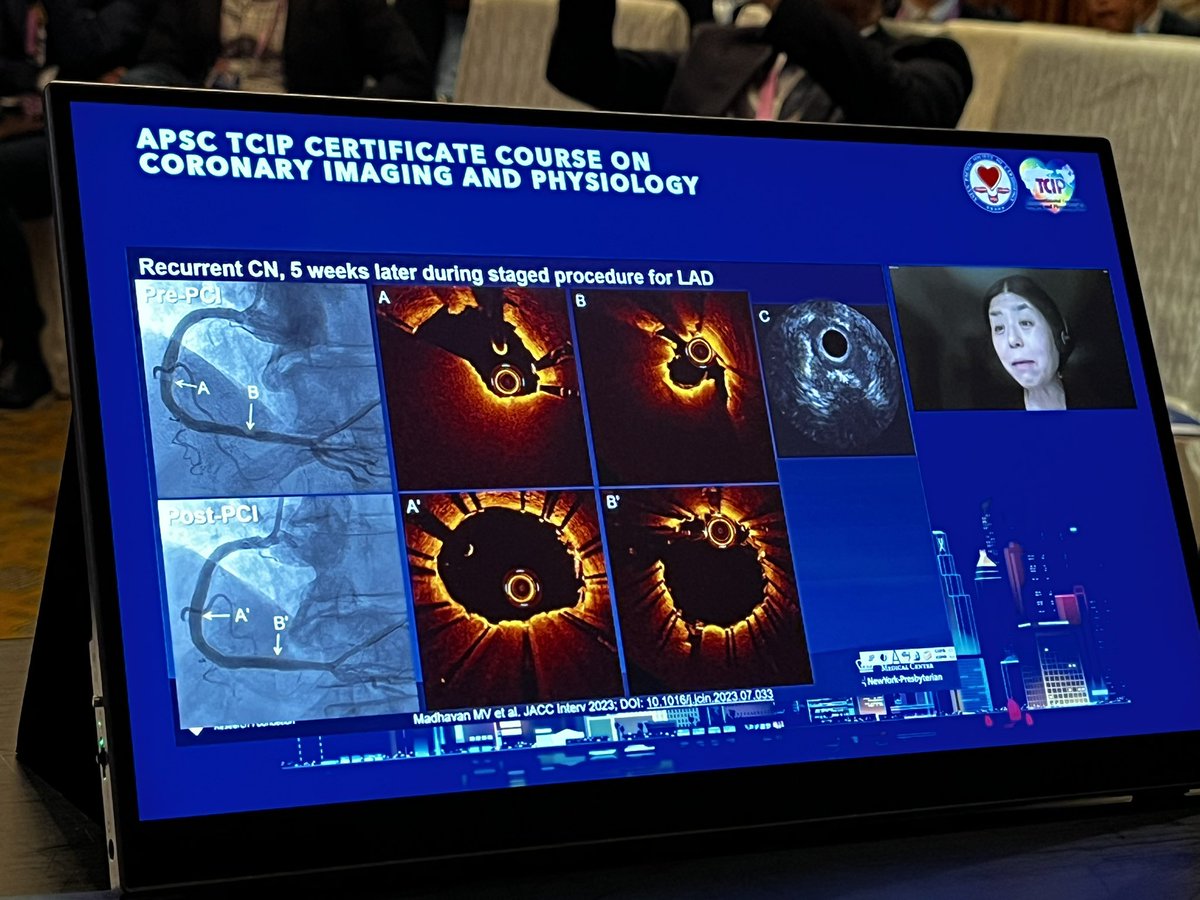 Tour de force by @MaeharaAkiko on eruptive vs non-eruptive calcific nodule. Eruptive CN allows stent expansion but poorer outcomes due to re-protrusion - TCIP APSC meeting