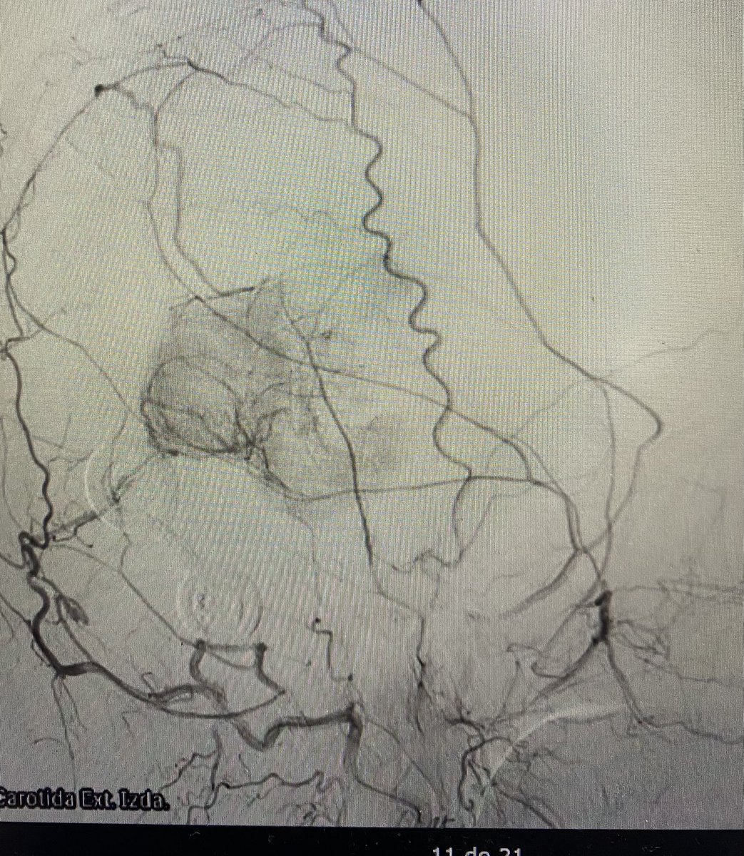 31 y/o male: headache, pineal tumor, and subacute hydrocephalus.Initial surgery: shunt, negative biopsy. InterHempPost approach limited by bleeding, confirming fibrous tumor. Arteriography shows ext. carotid contribution. Planning next step. What now?#neurosurgery #clinicalcase