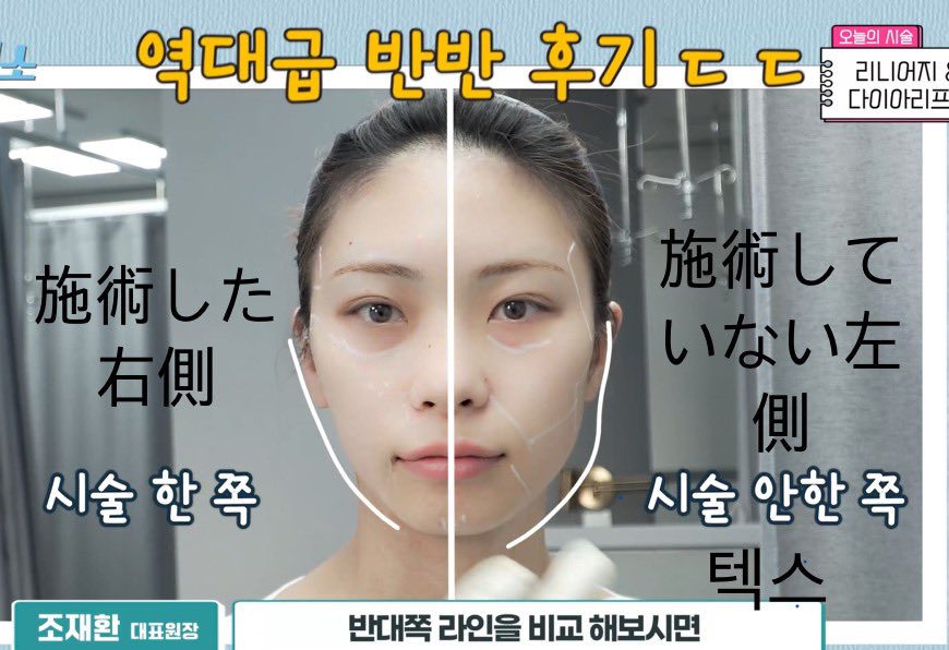 YOURCLINICJP's tweet photo. #ピコトーニング #釜山  でも1.9万₩ですって？
それに #ボトックス も1000₩？！

#釜山にも #ユアクリニック、#yourclinic #プサン店 の オープンイベント
西面駅7番出口のすぐ前

#しわボト1箇所 1000₩(#釜山店 限定)
#ポテンツァ  顔全体 9.9万₩

リツイートしておくと、11月以降も適用可能 https://t.co/mZ9GqufZmu