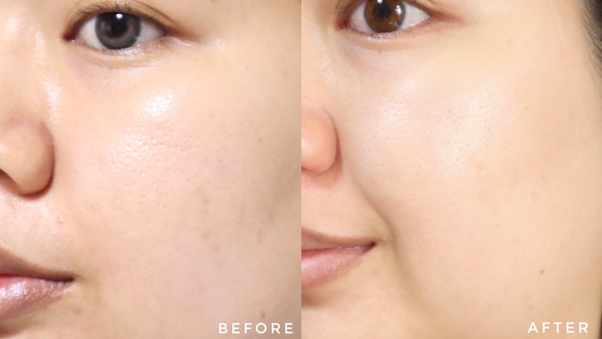 yingpeereview's tweet photo. ตัวช่วยกู้ผิวตอนต้องใช้ผิวเร่งด่วน ยกให้แอมพูล mesoestetic antiaging flash🪄✨กู้ผิวแบบจากโทรมๆ ให้ใสเด้งภายในข้ามคืน รอยดำรูขุมขนที่ดูชัดคือมันก็ฟูมันเต็มขึ้น อยากสวยเร่งด่วนทาเช้า-เย็นไปเลย เนื้อแอมพูลเขาเข้มข้นแต่ไม่หนักผิวเกินไป ซึมง่าย ชอบบ  #CelebSkinSecret #mesoestetic_th https://t.co/WyzjsDFKqa