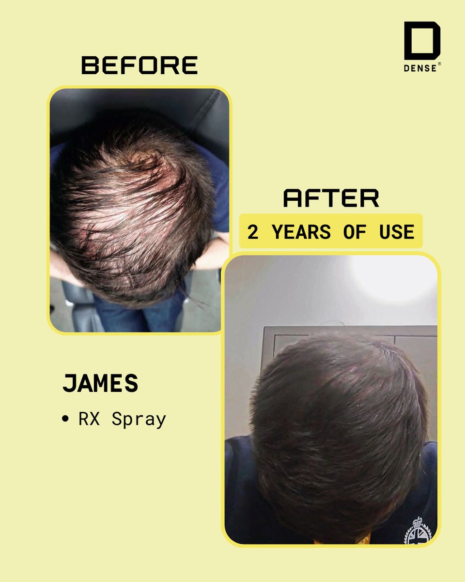 Want results like James? GHet in touch today! 

#hairgrowthtips #hairlossremedy #scalptreatment #thinhair #hairgrowthproducts #regrowhair #densehairexperts