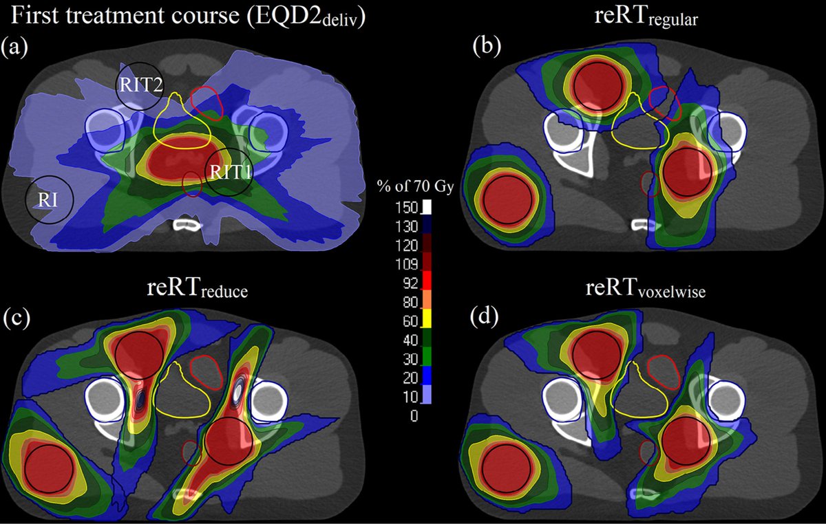 Re-irradiation requires dedicated planning solutions. We’ve previously reported on EQD2-based reRT planning accounting for previous dose. With collaborators at @RaySearch, we've now published the underlying optimisation algorithms doi.org/10.1002/mp.168… #medphys #radonc