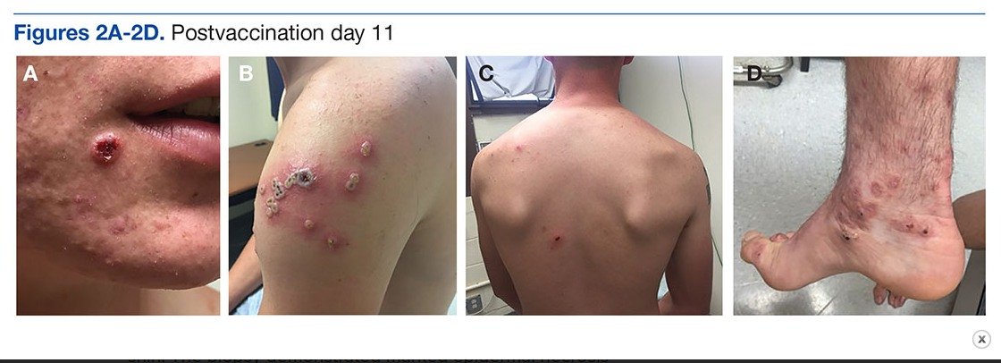 A 19-year-old active-duty marine presented to his battalion aid station with concern for a spreading vesicular rash 9 days after a primary inoculation with the smallpox vaccine.
mdedge.com/fedprac/articl…