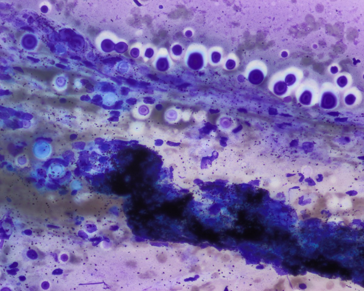 pepeheffernan's tweet photo. CC302. Gloomy Sunday case. In his 50s, HIV+, mediastinal adenopathies. Lymphoma is suspected. EBUS-TBNA. You can see the antracotic pigment and something else. #cytopath 
@DrBMcGinn @kriyer68 @saada_vsaada @padmapathology1 @smlungpathguy @TristanRutland7 @SaudiCytopathol https://t.co/Hbcpqvvfmo