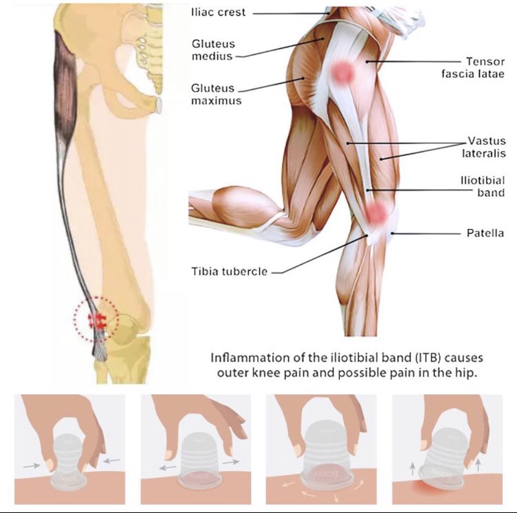 shane10586's tweet photo. ITB Syndrome &amp; Cupping Therapy

Great article and instructional video of what this therapy entails and looks like. I also do this treatment with added Acupuncture and Tuina massage. 

Credit for photo and article:
Learn more 👉 https://t.co/VCASHx9joj https://t.co/W1jt0XqyO9