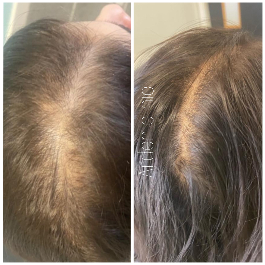 ArdenClinic's tweet photo. Are you facing hair loss or thinning? There's a solution to concealing a bald spot or receding hairline, and it begins with regaining your hair! ​​​​​​​​No surgery necessary.

Discover the simplicity of hair restoration, freeing you from the constant worry and hop https://t.co/MTgiPDvmY5