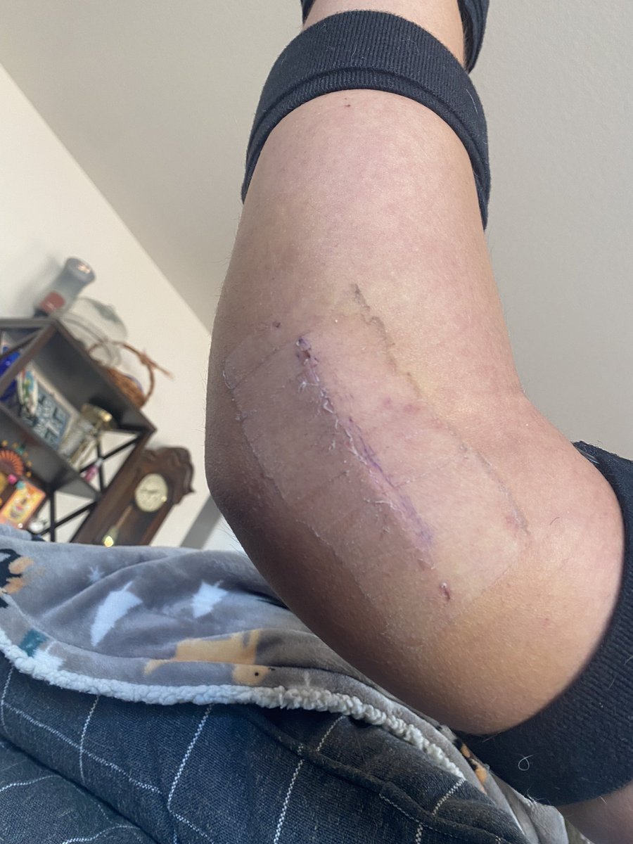 Max_alers's tweet photo. On 9/28 I was diagnosed with a fully torn UCL on the humeral attachment. 10/17 full reconstruction with internal brace. I was given two options…hang them up or create the most insane comeback story there is. In my eyes option one wasn’t an option. Cheers to to Tommy! 🍻 https://t.co/rem4JnFvAR