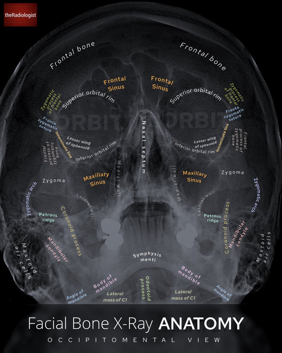 radiologistpage's tweet photo. CT is more sensitive and reliable for facial trauma however in some places in the world where CT is less accessible, facial bone X-Ray remains a key part of workup

Here is OM facial bone anatomy and a strategy to assess https://t.co/cPFRRTvPt7