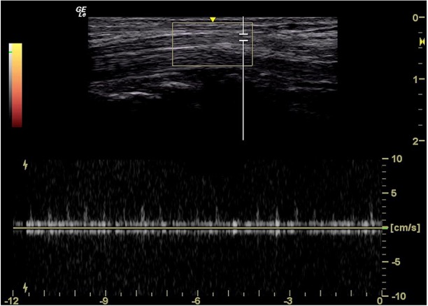 MSOPLab's tweet photo. #DopplerImaging is a potential diagnostic biomarker for #CarpalTunnelSyndrome, but non-standardized #MedianNerve #sonography protocols impact reliability. Standardized protocols will improve clinical accuracy and advance research. #MedicalResearch Read: https://t.co/xJBDyvn0pP https://t.co/A4t0l2ef8n