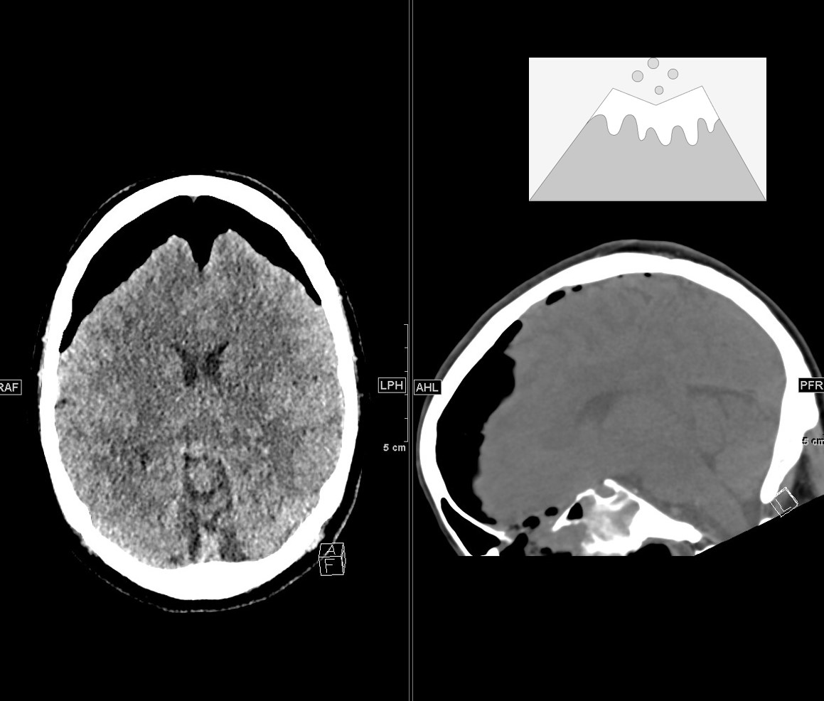 Adult patient with altered mental status post-transnasal endoscopic surgery. Follow-up CT reveals new pneumocephalus. 🤔 Urgent decision: Should we alert the medical team? #Neuroradiology #emergencyalert #CT @NeuroSinai @MountSinaiDR @MountSinaiDMIR @MountSinaiNM