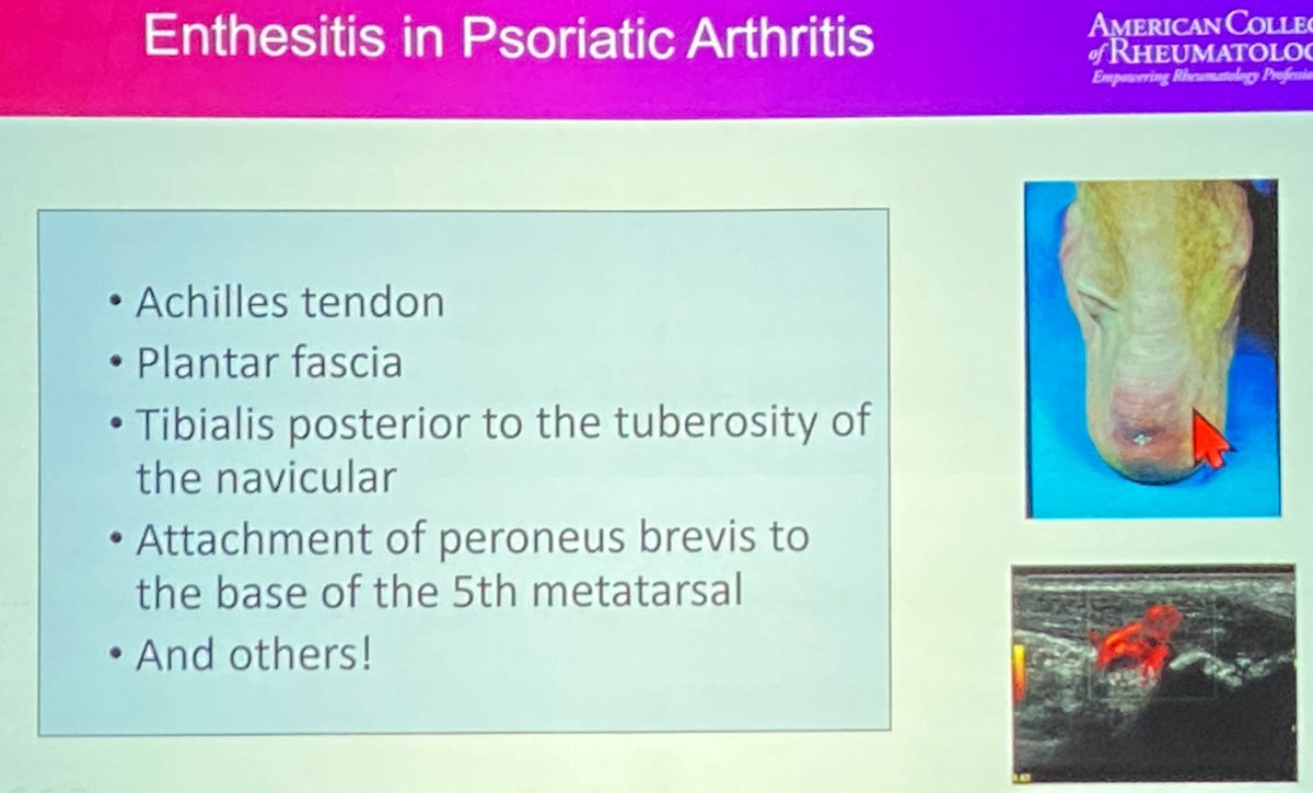 The places to look for #enthesitis in #PsA in foot/ankle

#ACR2023