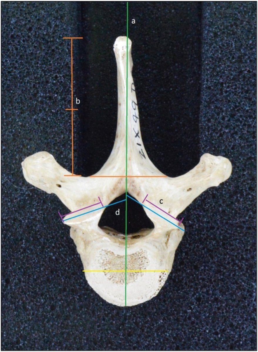 "Spinous process deviations in the upper thoracic spine are most probably  the result of random normal variations between individuals and are more  frequent in males. "

👇👇👇

sciencedirect.com/science/articl…