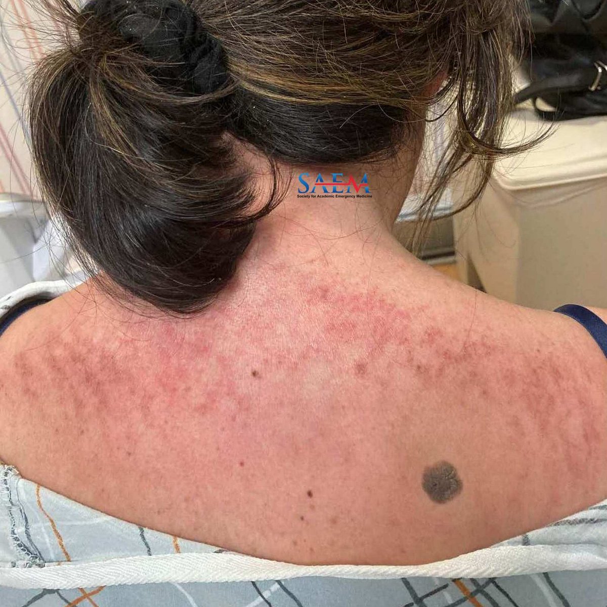 SAEM Clinical Images Series: More than Skin Deep The combination of skin rash and shortness of breath may not be as random as first glance would suggest... Check out this case from @NYPQ_EM. aliem.com/saem-clinical-… @SAEMonline