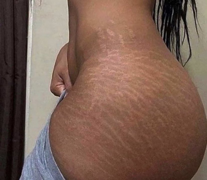 we love some beautiful stretch marks  💕 guys what’re your thoughts on them ?