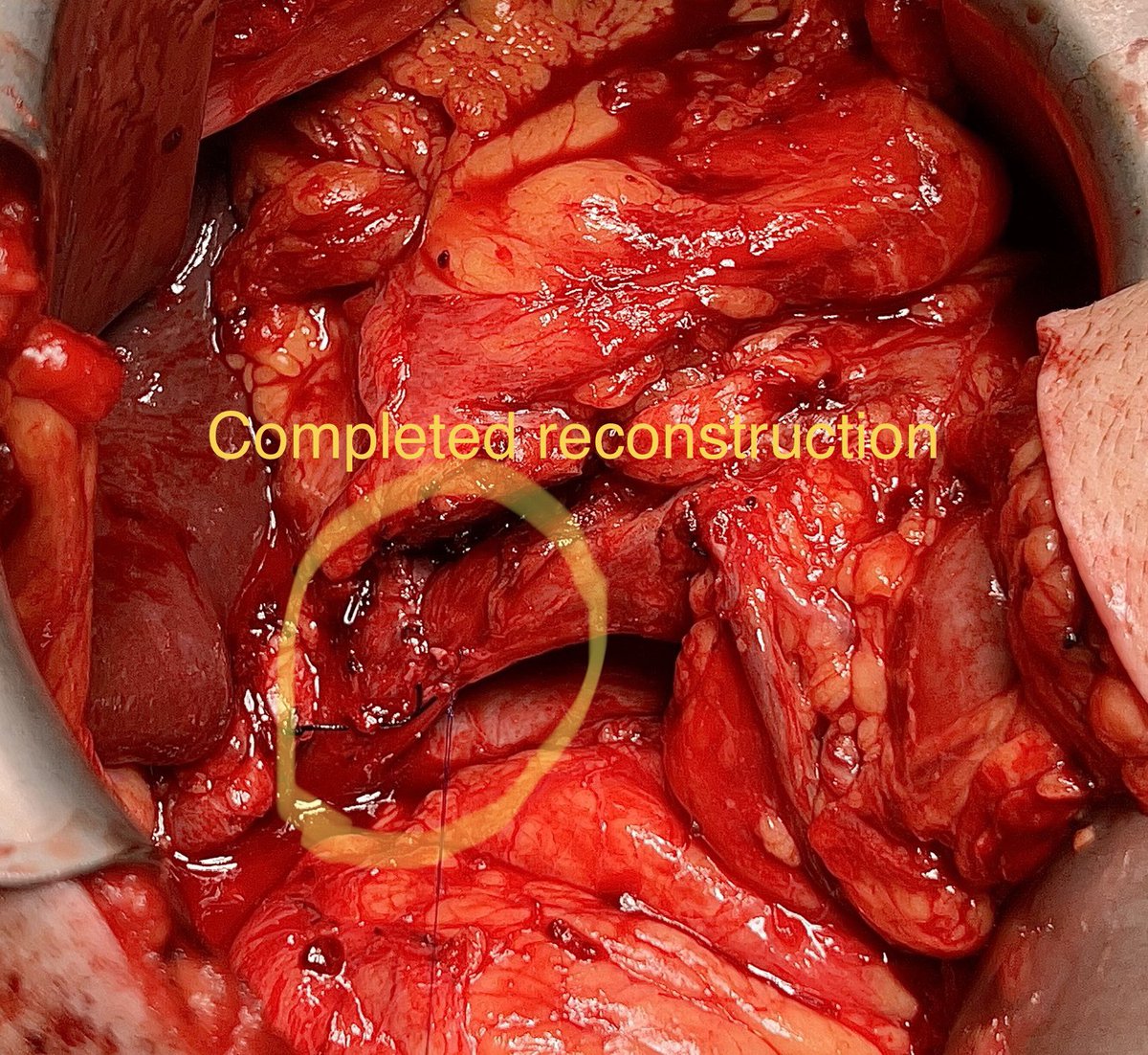 Csaba Gajdos MD, FACS, FSSO (@csabagajdos1) on Twitter photo Portal vein resection and reconstruction during Whipple: co-surgery Dr Zaaroura <a href="/Jacobs_Med_UB/">Jacobs School at University at Buffalo</a> <a href="/UBSurgery/">Department of Surgery | University at Buffalo</a> <a href="/KaleidaHealth/">Kaleida Health</a> Portal vein resection and reconstruction during Whipple: co-surgery Dr Zaaroura <a href="/Jacobs_Med_UB/">Jacobs School at University at Buffalo</a> <a href="/UBSurgery/">Department of Surgery | University at Buffalo</a> <a href="/KaleidaHealth/">Kaleida Health</a>
