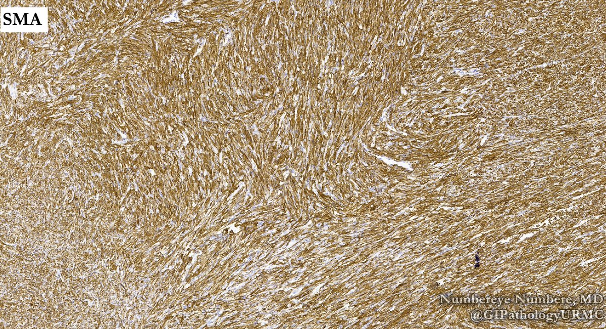 This small bowel leiomyosarcoma is eye-catching. #Pathology #SurgPath #GIPath #PathBoards #PathTweetorial #Histopathology #PathologyCases #Grossing #PathTweetAward