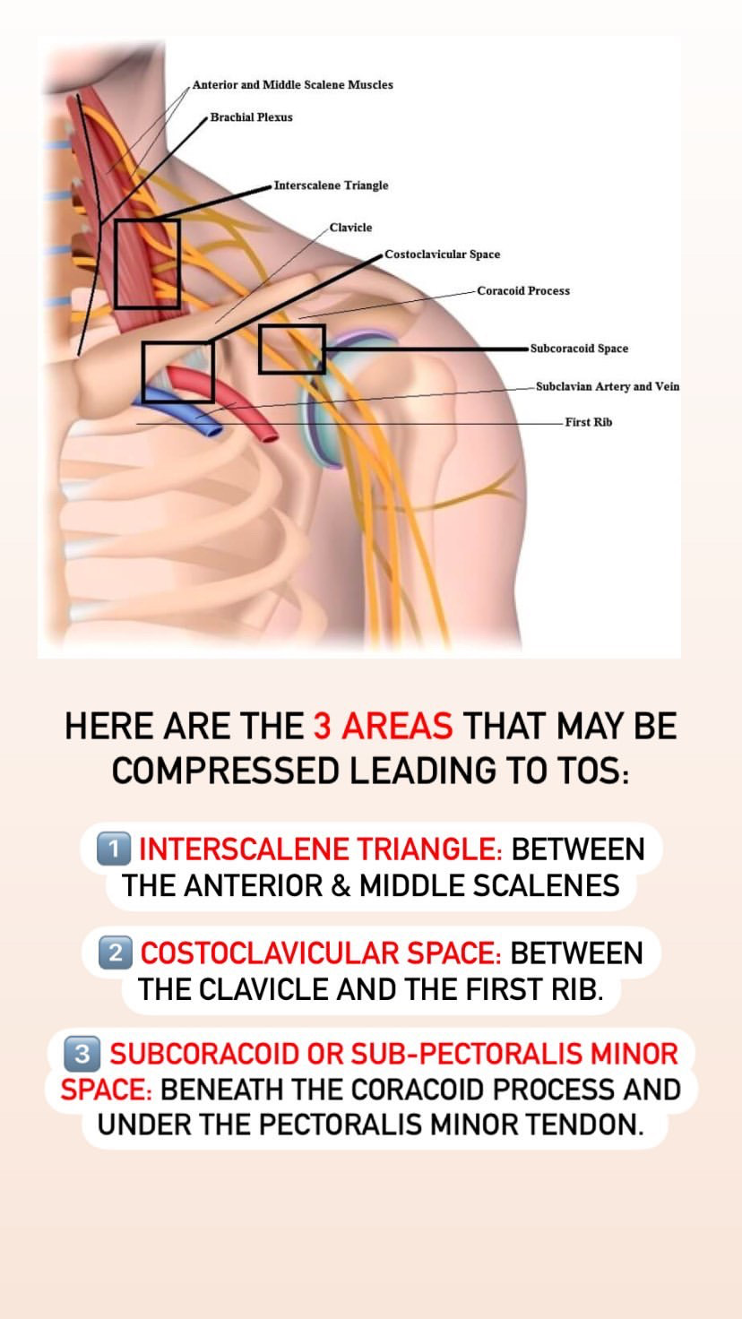 Prehab®️ on X: Pain with Thoracic Outlet Syndrome (TOS) presents anywhere  between the neck, face, occipital region or into the chest & shoulder, with  paresthesia into the upper extremity based on where