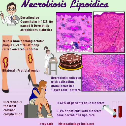 schowardjd's tweet photo. @BrownJHM Necrobiosis lipoidica  

🔹a chronic granulomatous dermatitis of unknown cause most often associated with diabetes mellitus.

🔹suspect immune-mediated vascular disease leads to abnormal collagen changes.   

(image credit: @DrSampyRoy, #RoyPath, https://t.co/GgkAxD1pU5) https://t.co/FZEHnKVj8G
