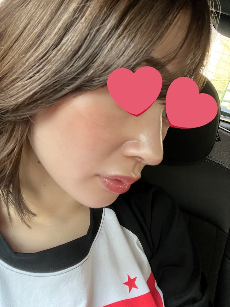 Tweely_3_'s tweet photo. 韓国でデュアルピーチリフト（計10本）、目の下の脂肪再配置、目の下と前頬の微細脂肪移植、ほうれい線フィラーしてきた❤️どっちもノーマルカメラで加工ゼロなんやけど、若返る😭
執刀医はイム院長！めっちゃ優しくて自分に合った施術メニュー組んでくれるよ！今年28歳まだまだいけます！ https://t.co/FqTtvLbcmO