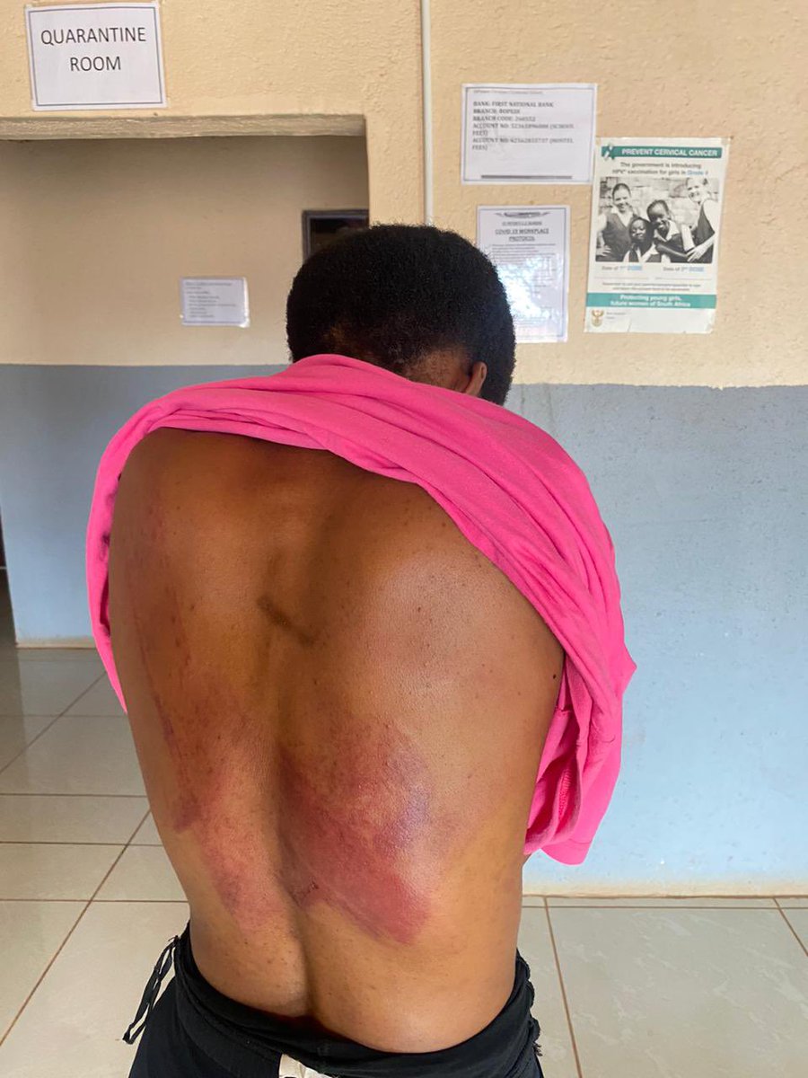 AdvoBarryRoux's tweet photo. This is a grade 12 learner at St Peter's, Christian church school in Mohlaletsi, limpopo, This learner was beaten by a teacher called Matibidi Sam Diketso for being late for church. https://t.co/SJJlB6onXG