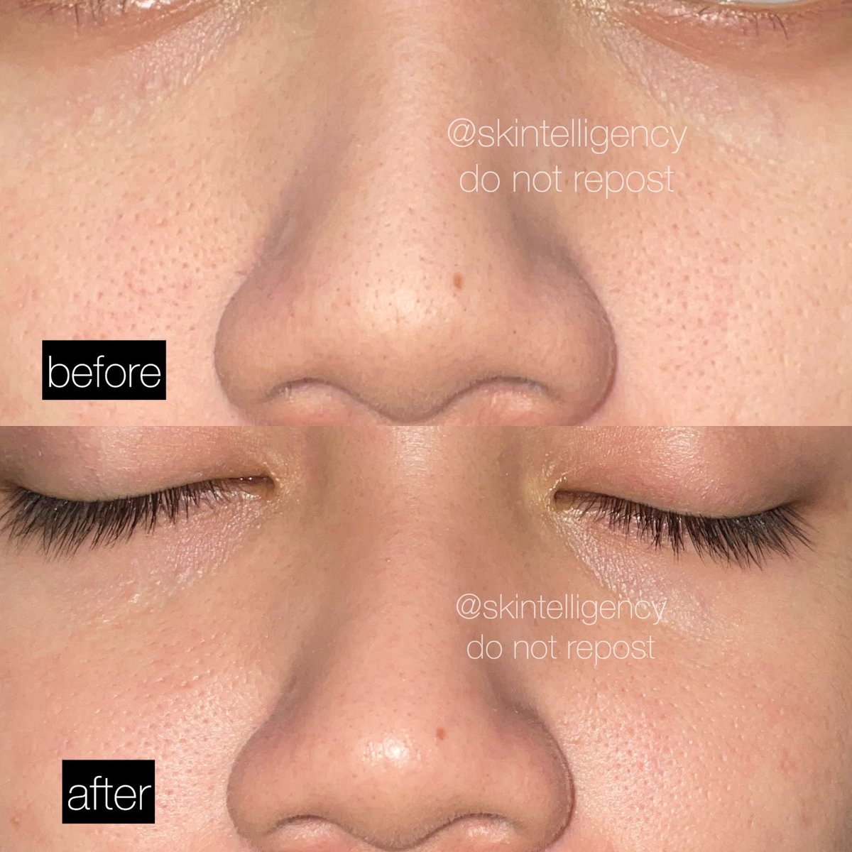 litchycoral's tweet image. ini cara yg aku lakuin buat bikin hidung stroberi bertekstur jadi jauh lebih bersih + komedo nya berkurang!🍓✨

a thread