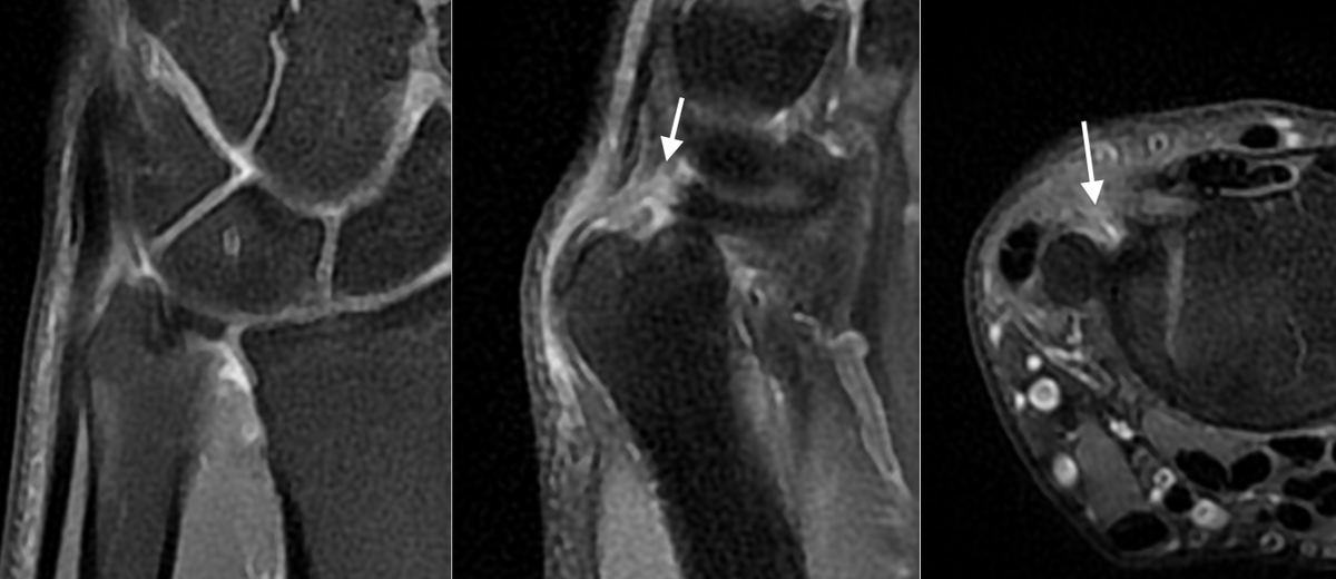 Complete tear of the dorsal capsular insertion of the TFC (Non-Palmer injury). Remember to always evaluate the sagittal views. Dorsal detachments are common and easily overlooked. See the normal TFC disk in coronal images. Previous MRI reported as normal.