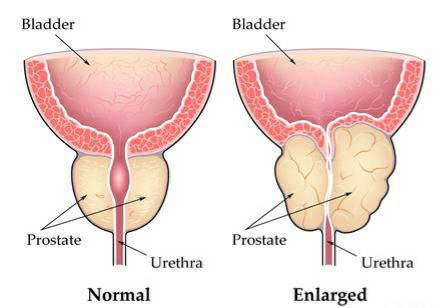 drkasenene's tweet image. November is prostate awareness month.

Tips/foods for a healthy prostate.

1.Regular exercise- 3 hours a week
2. pumpkin seeds
3. red foods - tomatoes, watermelon 
4. Green/ matcha tea
5.  A supplement with zinc, lycopene, saw palmetto, phytosterols
6. Prunus Africanus tree bark