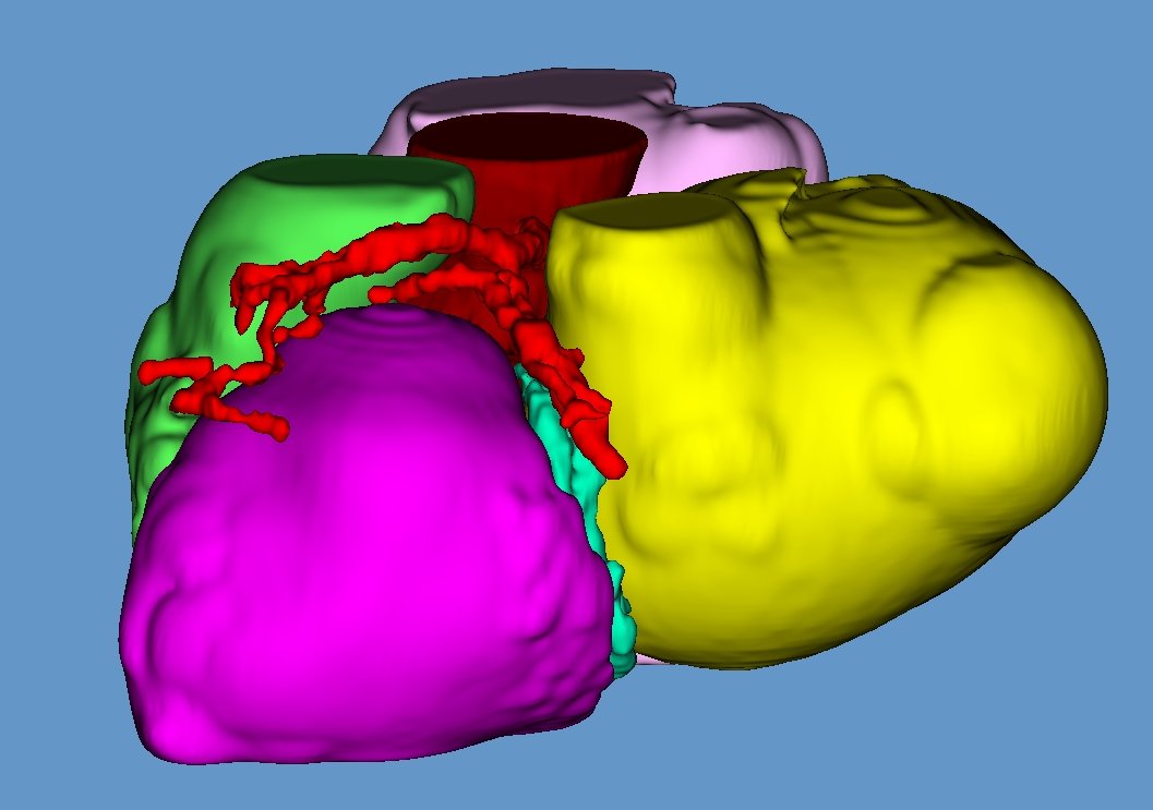 Virtual 3D model (CMD I) with double mitral lesion and severe MAC allows preoperative planning to estimate ideal prosthetic size for the patient, reducing risks
<a href="/3d_maranon/">FabLab 3D Hospital Marañón</a> <a href="/DiegoMonzonDiaz/">Diego Monzón Díaz</a> <a href="/CardiacMaranon/">Cardiac Surgery Gregorio Marañon Hospital</a> <a href="/rupermac/">Rubén Pérez-Mañanes, MD PhD</a> <a href="/calvoharo_ja/">José Antonio Calvo</a>  #UPAM3D #HospitalGregorioMarañon #impresion3D