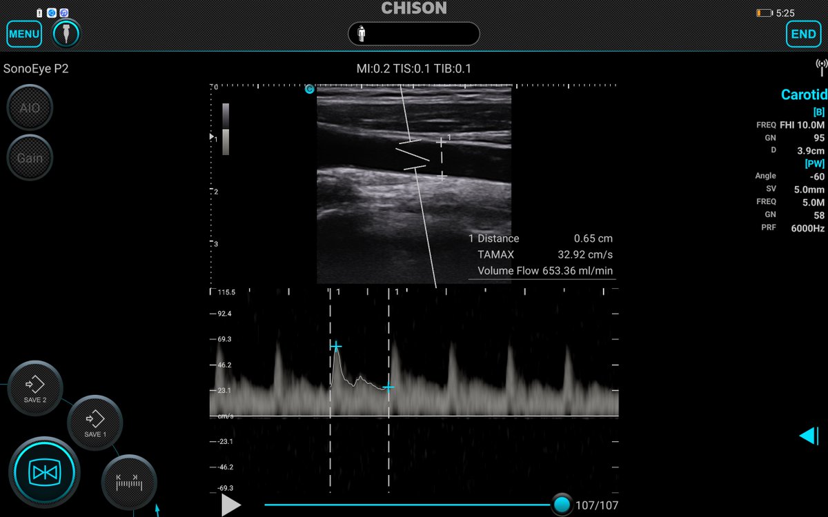 ✨ Unbelievable clinical images from the palm-sized wonder – SonoEye! Connect to your device, start in seconds. Simple, efficient, and fits right in your hand. Explore clinical imaging like never before!
Learn more at chisonsonoeye.com
#SonoEyeMagic #PointofCareUltrasound