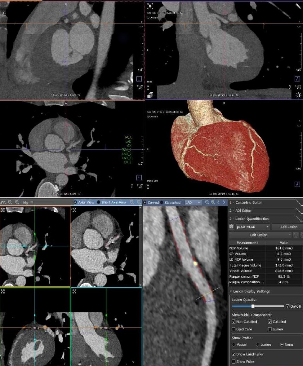 Danish Cardiovascular Academy (@dcacademydk) on Twitter photo 🔊 REGISTRATION OPEN: Join the one day symposium in Odense on Cardiac CT and AutoPlaque organized by DCAcademy grant recipient <a href="/SelmaHasific/">Selma Hasific</a>.
👉 Learn more about the programme and sign up here:
bitly.ws/KVQL 🔊 REGISTRATION OPEN: Join the one day symposium in Odense on Cardiac CT and AutoPlaque organized by DCAcademy grant recipient <a href="/SelmaHasific/">Selma Hasific</a>.
👉 Learn more about the programme and sign up here:
bitly.ws/KVQL