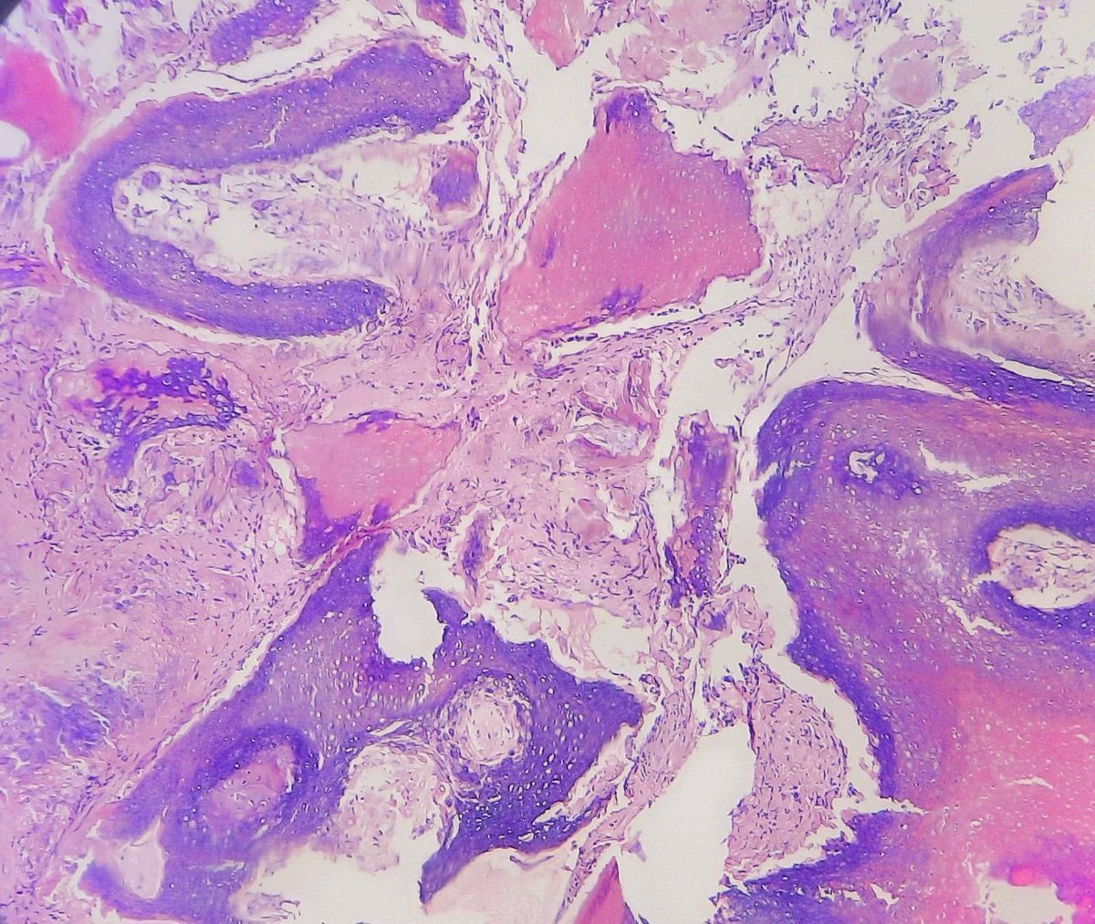 amnabruno's tweet image. 3 year old male, cystic swelling left ear. 
⁉️Solid nests of basaloid cells undergoing abrupt trichilemmal-type keratinization
❓️What am I? 
#PathTwitter #TwitterPath #AnatomicPathology