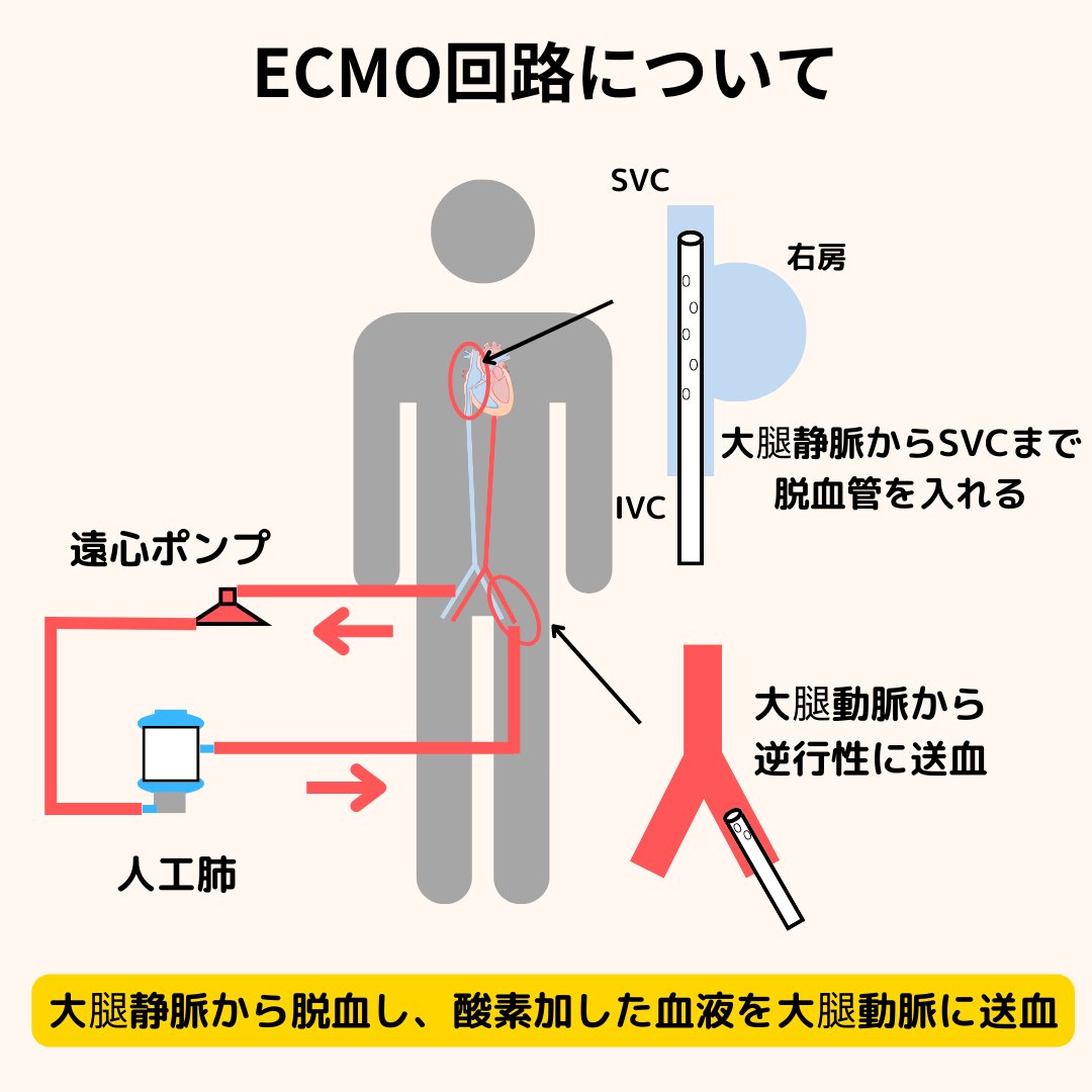 cetenshoku's tweet photo. 本日は��ECMO】について
管理に役立つ情報です。
・ECMO血流量が低下している？
・設定変更していないのになぜ？
と思ったことありませんか？
なぜ流量が変化するか理解すれば怖くありません。
新人のNs.、CEに見てほしいです。
参考になったらいいね、リツイートお願いします。
＃集中治療 https://t.co/FrYbTASn6S