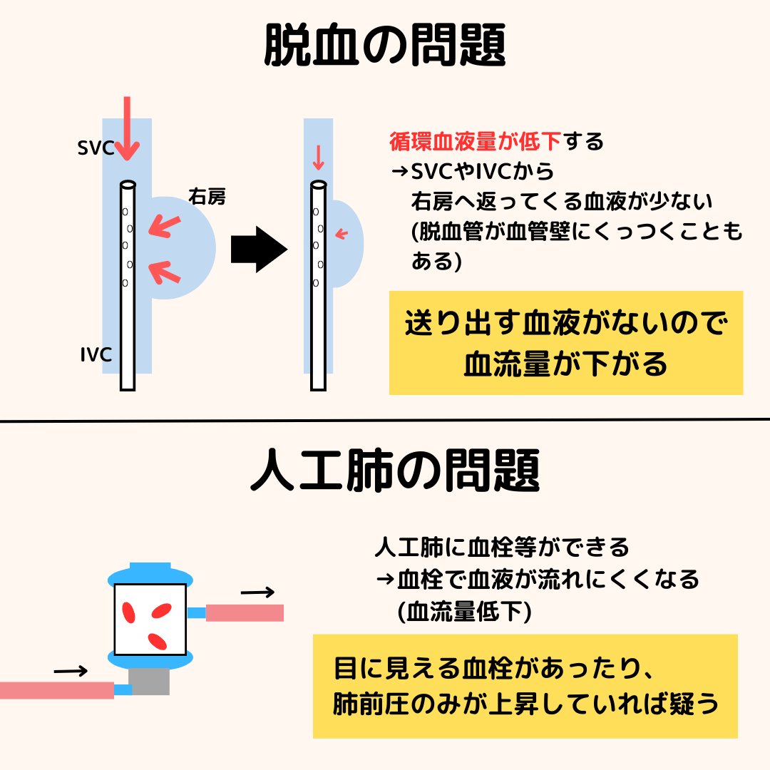 cetenshoku's tweet photo. 本日は��ECMO】について
管理に役立つ情報です。
・ECMO血流量が低下している？
・設定変更していないのになぜ？
と思ったことありませんか？
なぜ流量が変化するか理解すれば怖くありません。
新人のNs.、CEに見てほしいです。
参考になったらいいね、リツイートお願いします。
＃集中治療 https://t.co/FrYbTASn6S