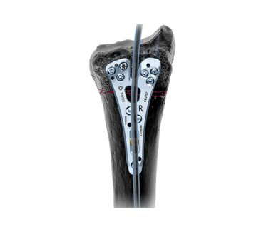 The Medartis FPL Plate is designed to support the lunate facet, DRUJ and the radial styloid. It provides improved anatomical fit adapted to the volar aspect of the distal radius* and the ability to achieve very distal plate positioning. *Evaluated on 250 cadaver bones.