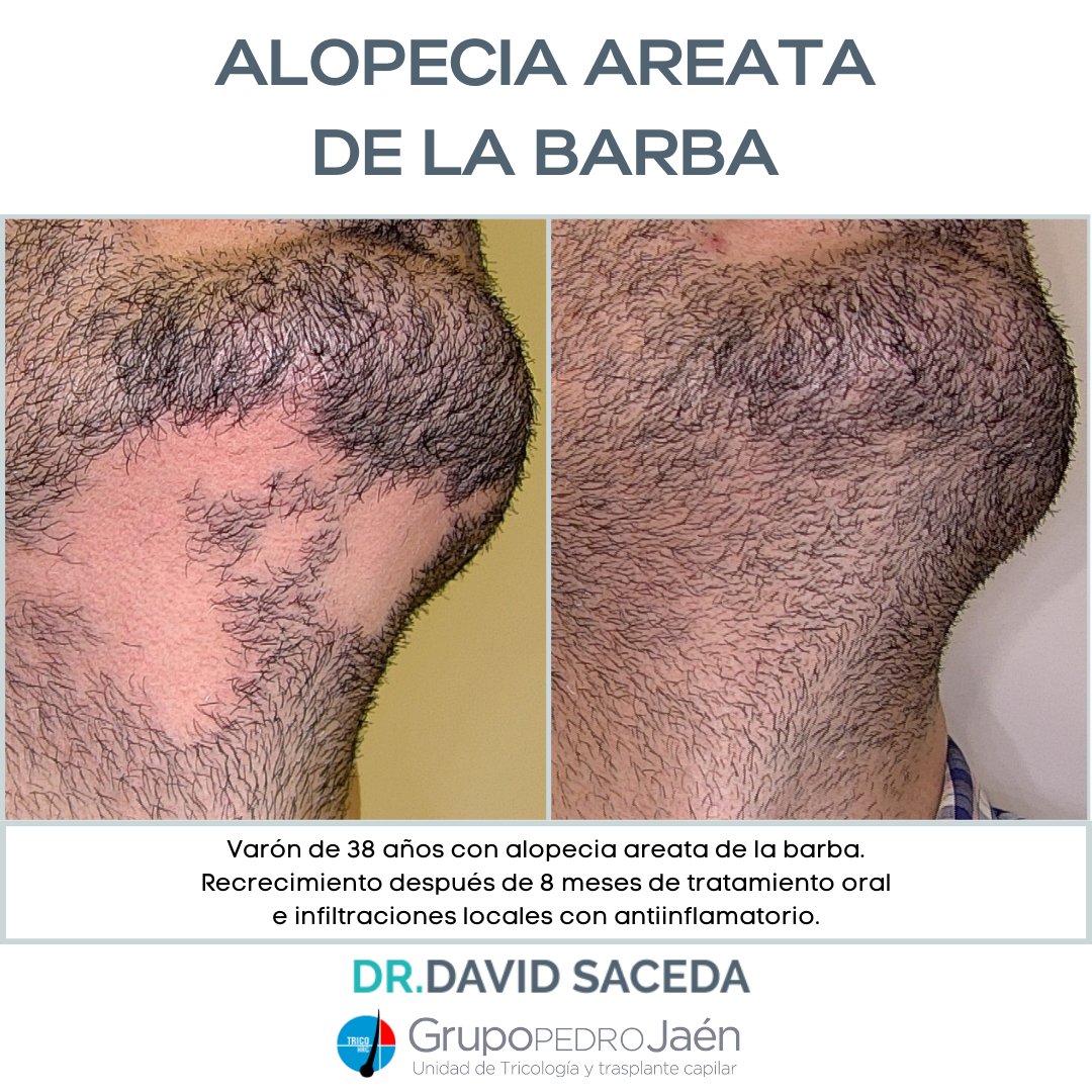 Desaze's tweet photo. La #alopeciaareata de la #barba 🧔🏻‍♂️ es un problema  frecuente entre los hombres.

✔️ Suele aparecer como un área de alopecia ovalada

✔️ Puede remitir de forma espontánea

✔️ Si se prolonga en el tiempo es necesario usar tratamiento local (infiltraciones), incluso oral https://t.co/UYiKnJWzGW