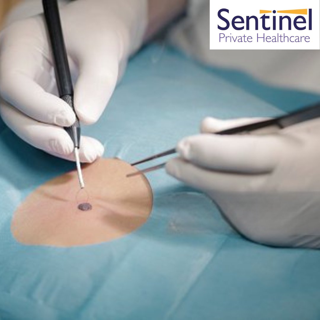 Sentinel_PHCare's tweet photo. 🩺 Trust Sentinel Private Healthcare for expert mole removal services! Our experienced clinicians provide safe and effective procedures.  Say goodbye to unwanted moles! ✨

🌐 Learn more: https://t.co/xyXVm0puNu
.
.
.
#MoleRemoval
#DermatologyServices
#SentinelPrivateHealthcare https://t.co/vGelZFNqSP