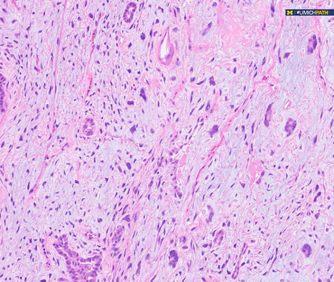 Are you ready for the #COTW?
This case is from a 38-year-old female with a prior surgical history of a breast lumpectomy. She now presents with a lung mass. What is your diagnosis?