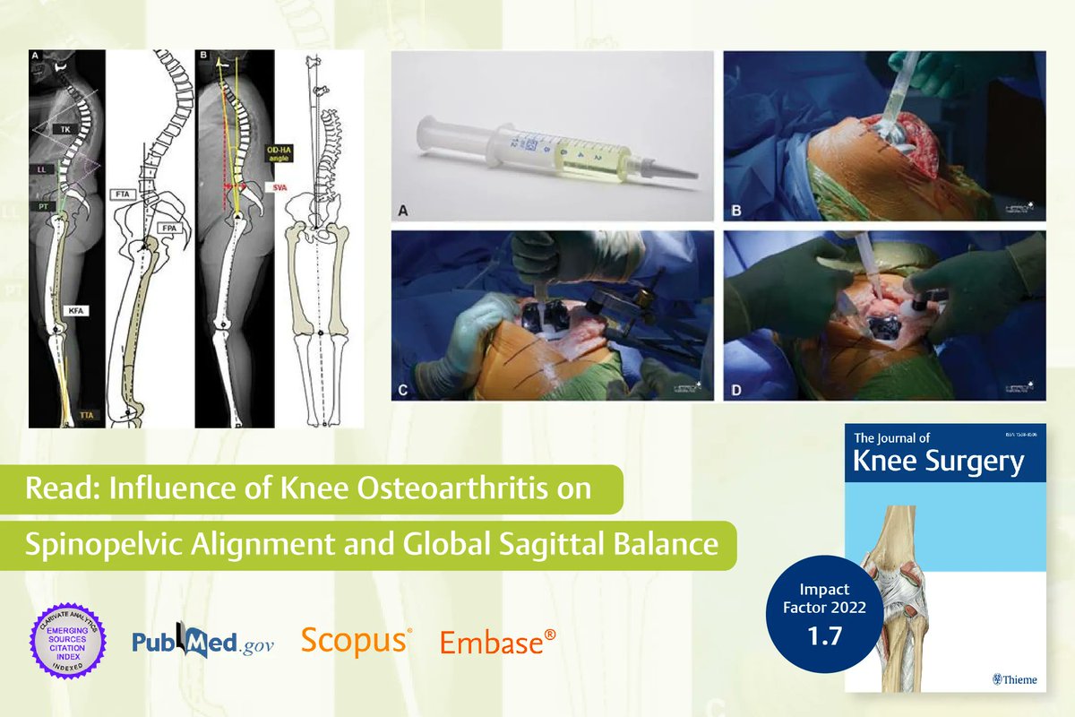 ThiemeIndia's tweet image. #Osteoarthritis of the knee is thought to lead to a loss of #LumbarLordosis as a compensation for knee flexion contracture. Changes in #SagittalAlignment are not limited to the lumbar spine and involve a complex interplay...Read Full Article: buff.ly/43kM2fN