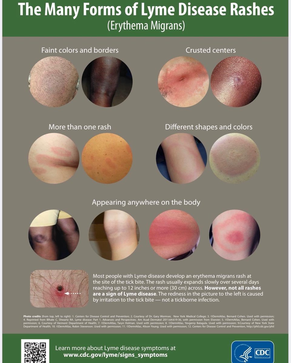Middleagemom's tweet photo. Worth sharing over and over again. The erythema migrans (EM) Lyme rash doesn’t just look like a bull’s-eye. In fact, the bull’s-eye is only seen in a small % of cases. As well, not everyone gets, or sees, a rash. #Ticks #Tickborne #Erythemamigrans #Lyme #Betickaware #Stopthebite https://t.co/BAhUrWbFCk