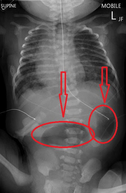 RBC On Twitter Sthanu5 Duodenal Atresia Is A Congenital Intestinal rbc-on-twitter-sthanu5-duodenal-atresia-is-a-congenital-intestinal