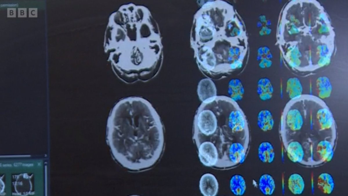 Prof James Teo (@jthteo) on Twitter photo Glad to host BBC London at <a href="/KingsCollegeNHS/">King's College NHS</a> for #NHS75 on using radiology #AI to help deliver more effective treatment of #stroke for patients throughout London and South East.
<a href="/NHSTransform/">Transforming health and care</a> is supporting medical device AI use in clinical pathways #aiforhealth Glad to host BBC London at <a href="/KingsCollegeNHS/">King's College NHS</a> for #NHS75 on using radiology #AI to help deliver more effective treatment of #stroke for patients throughout London and South East.
<a href="/NHSTransform/">Transforming health and care</a> is supporting medical device AI use in clinical pathways #aiforhealth