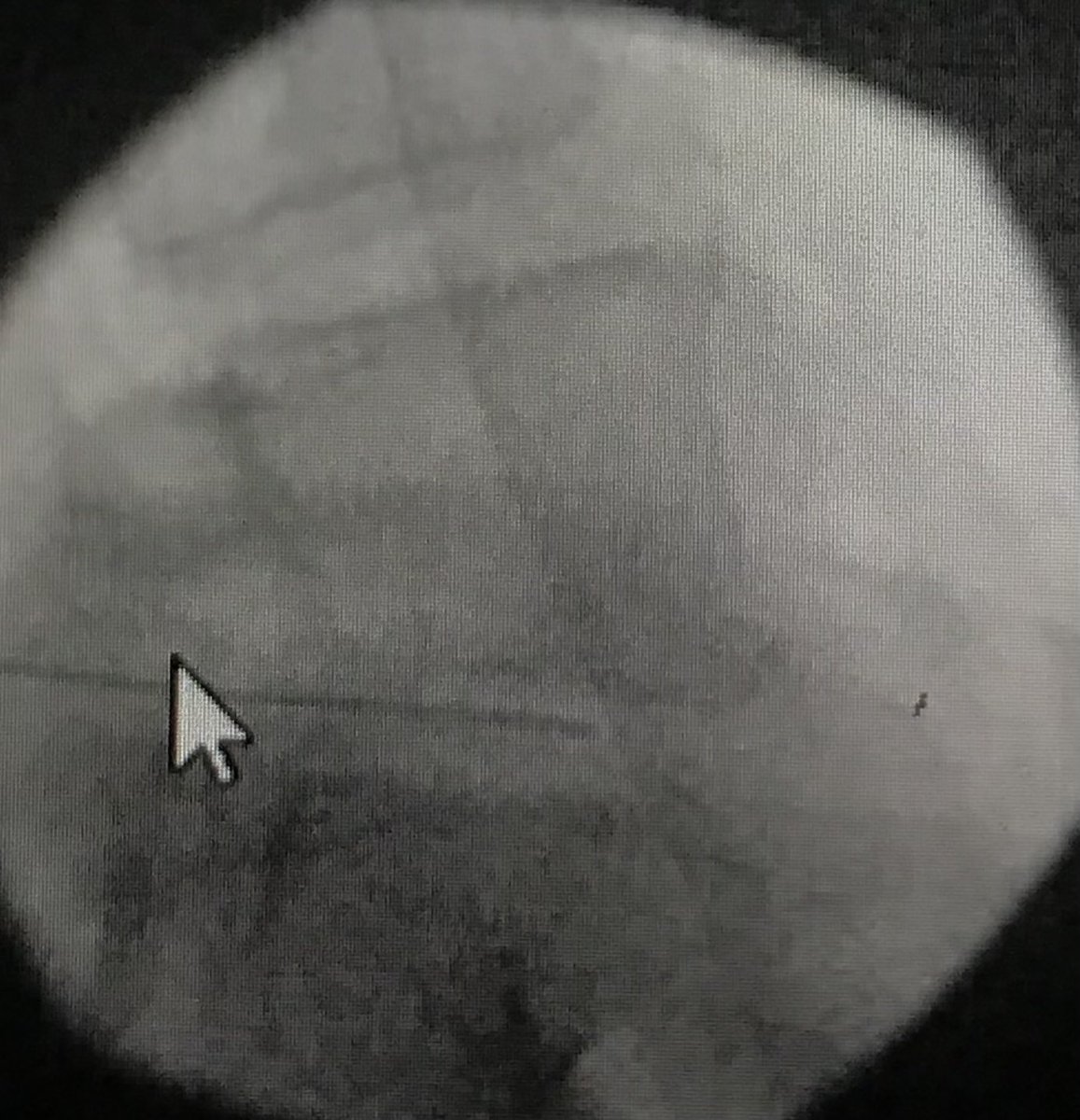 DraCBatet's tweet photo. Hoy hemos iniciado en nuestra Unidad de Dolor @ConsorciCSI el tratamiento de #dolordiscal #discopatía mediante Láser y PRP. Nuevas perspectivas para tratar el #dolorencolumnavertebral. @SEMDOR2 #herniadiscal #protusiondiscal @ranm_es https://t.co/nRXVIi7ABB