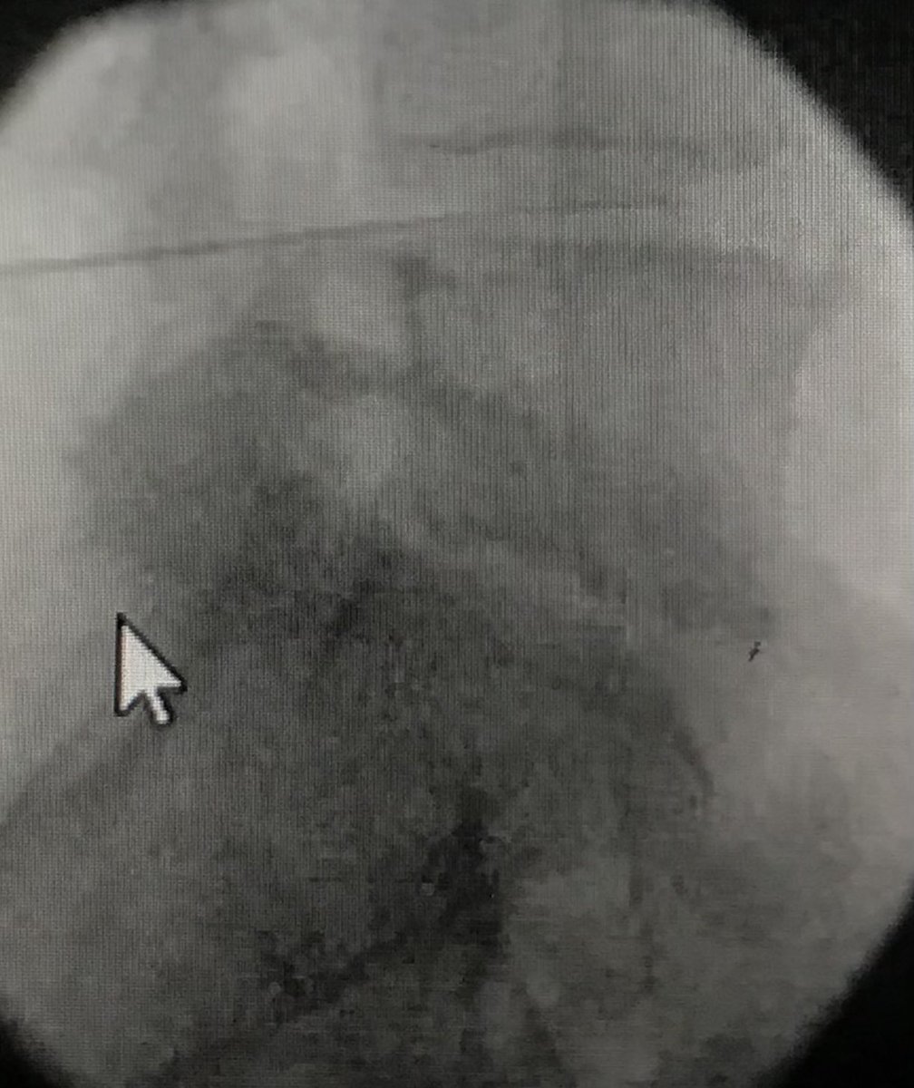 DraCBatet's tweet photo. Hoy hemos iniciado en nuestra Unidad de Dolor @ConsorciCSI el tratamiento de #dolordiscal #discopatía mediante Láser y PRP. Nuevas perspectivas para tratar el #dolorencolumnavertebral. @SEMDOR2 #herniadiscal #protusiondiscal @ranm_es https://t.co/nRXVIi7ABB